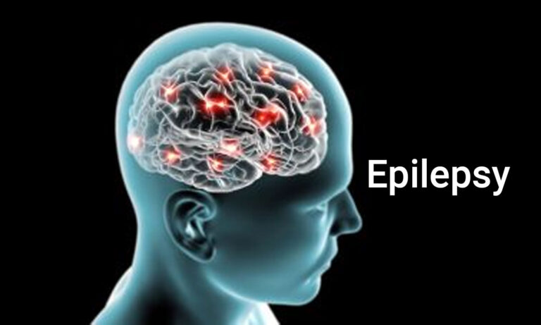 cannabis-for-epilepsy